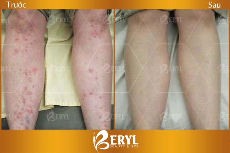 Hình ảnh trước và sau khi trị sẹo thâm chân bằng công nghệ Tảo Silic tại Beryl Beauty & Spa
