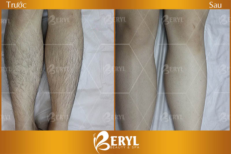 Hình ảnh trước và sau khi triệt lông bằng công nghệ SHR AFT IPL tại Beryl Beauty