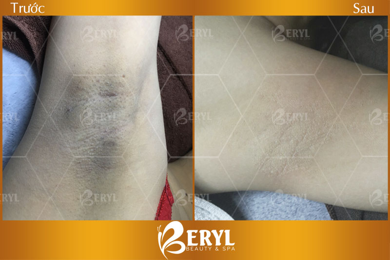 Hình ảnh trước và sau điều trị thâm nách tại Beryl Beauty