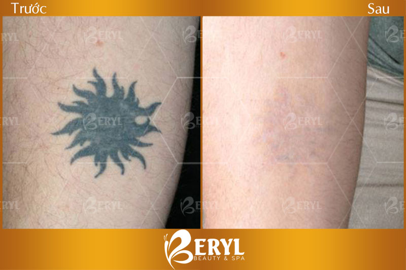 Hình ảnh trước và sau khi xoá xăm bằng công nghệ Laser Toning tại Beryl Beauty
