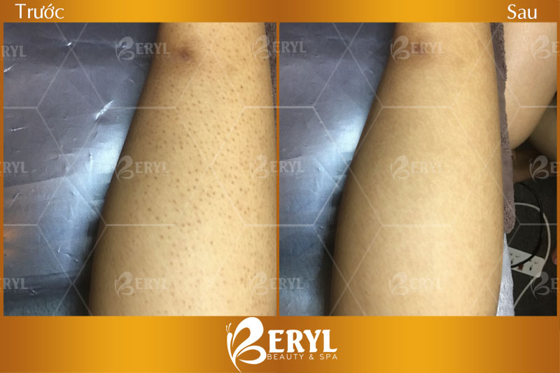 Hình ảnh trước và sau khi trị viêm nang lông bằng ánh sáng sinh học tại Beryl Beauty